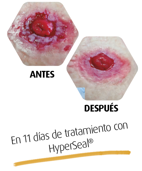 Caso clínico HyperSeal